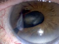Iris coloboma with a bridging iris tissue